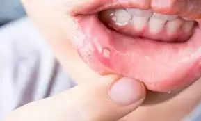 Remove your mouth ulcers with these home remedies, you will get relief immediately