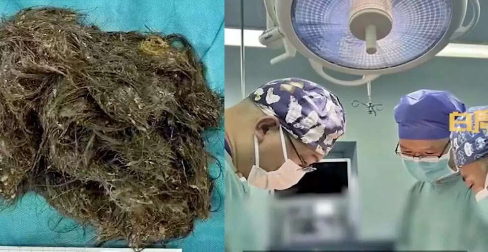 Teenager's Stomach Filled with 6 Kg of Hair: Shocking Medical Case