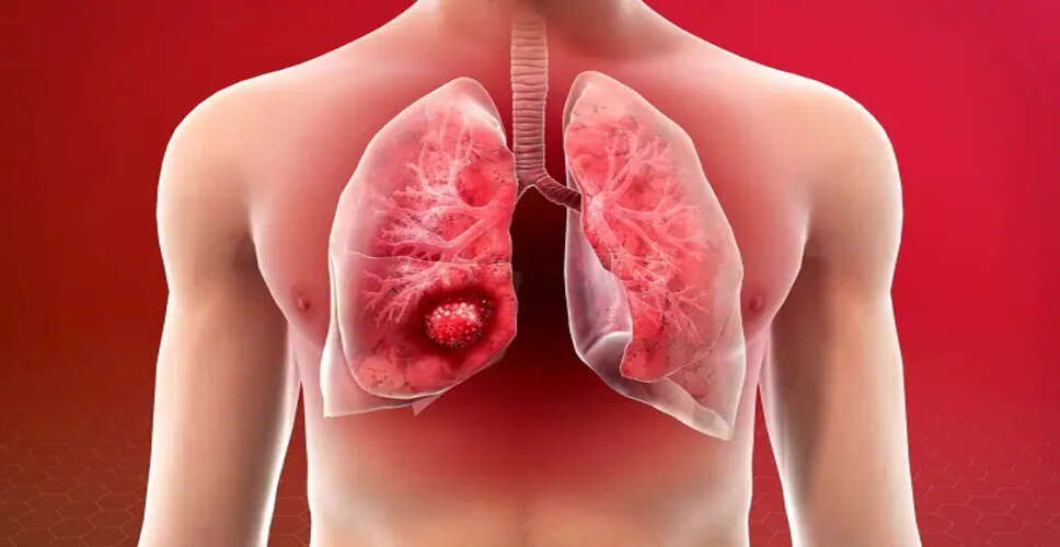 Understanding Lung Cancer: Symptoms and Prevention Tips