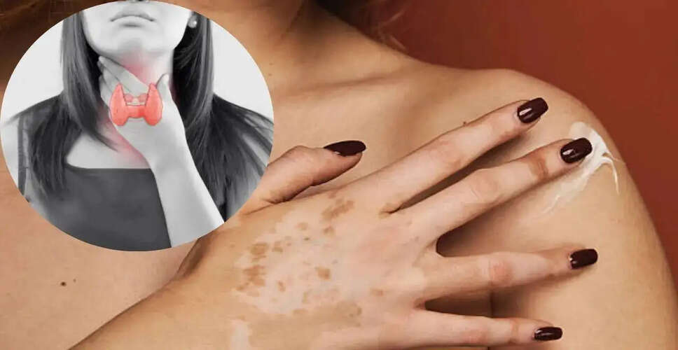 Understanding Vitiligo: The Connection to Thyroid Disorders
