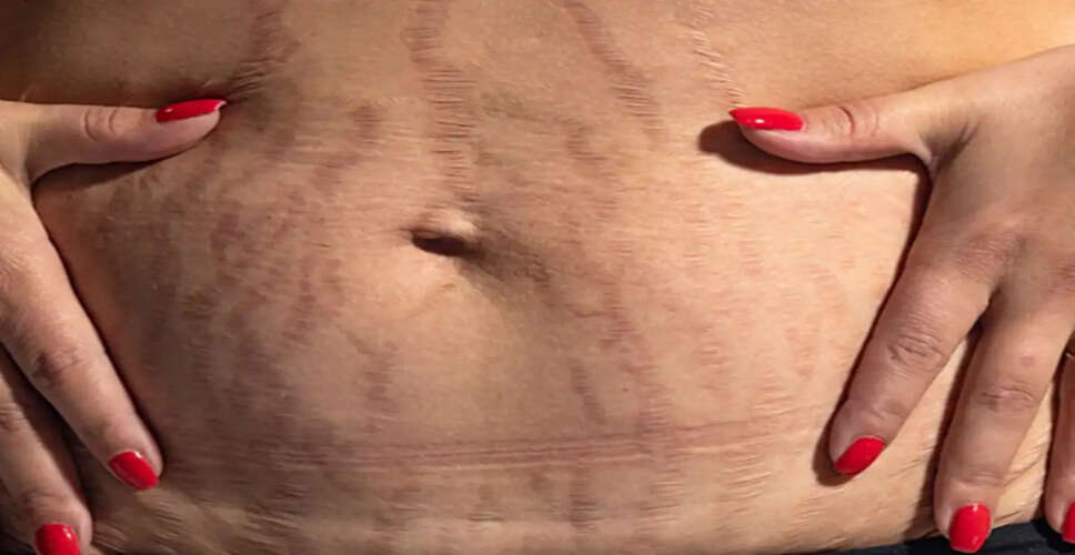 Effective Tips for Managing Pregnancy Stretch Marks