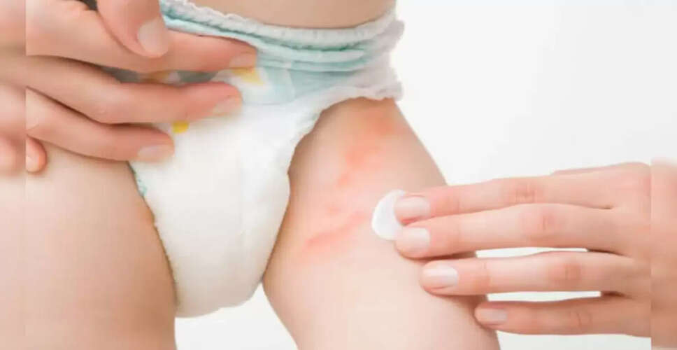 DIY Diaper Rash Cream: Simple Recipe for Parents
