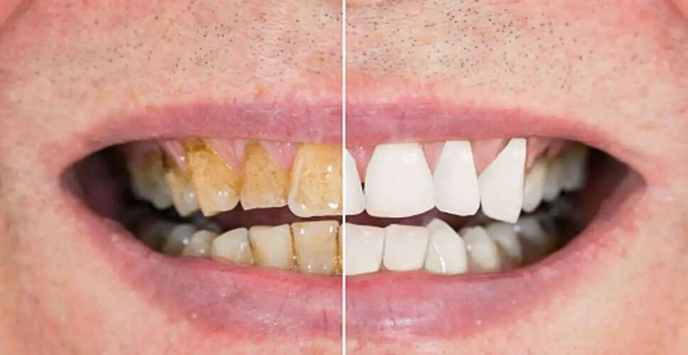 Effective Home Remedies for Whiter Teeth Using Baking Soda