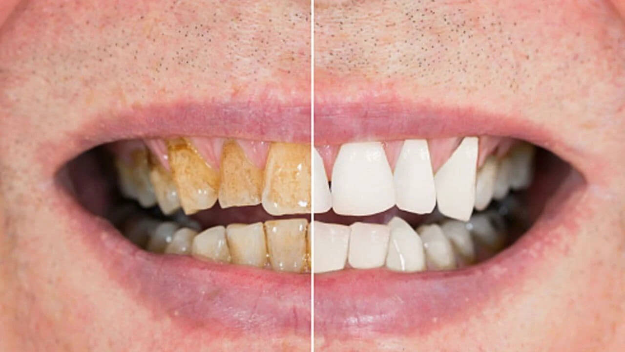Effective Home Remedies for Whiter Teeth Using Baking Soda
