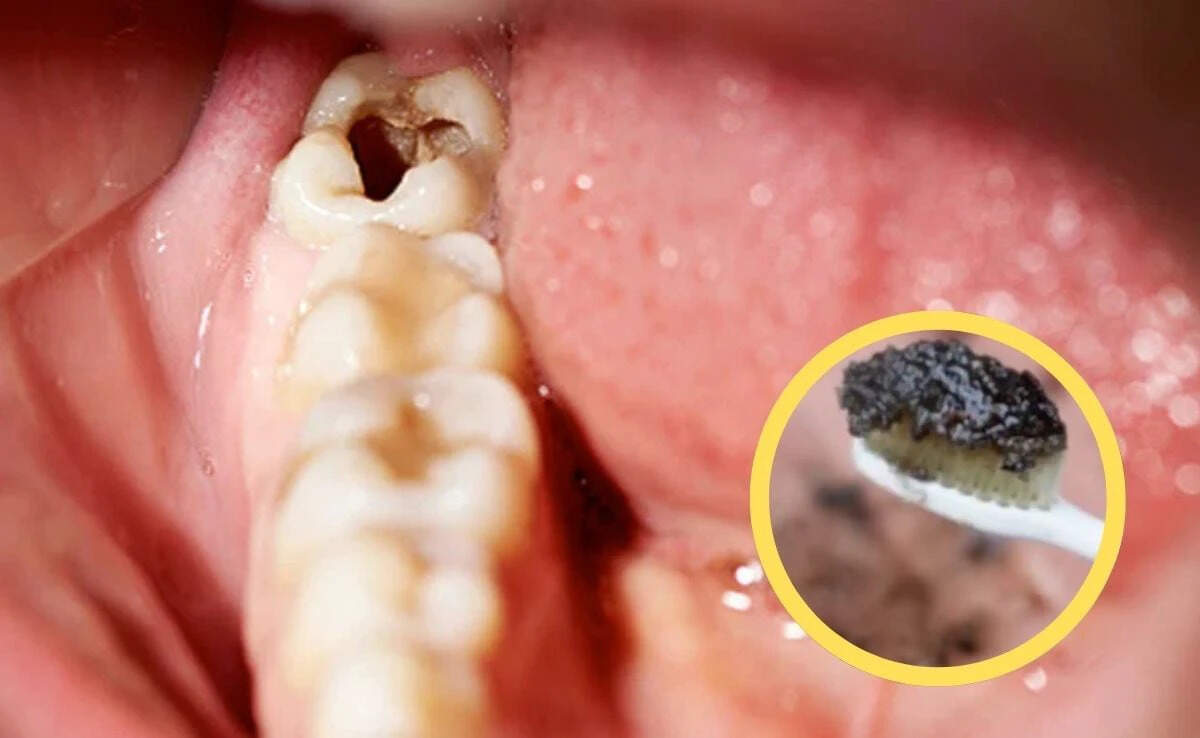 Homemade Toothpaste: A Natural Solution for Cavities