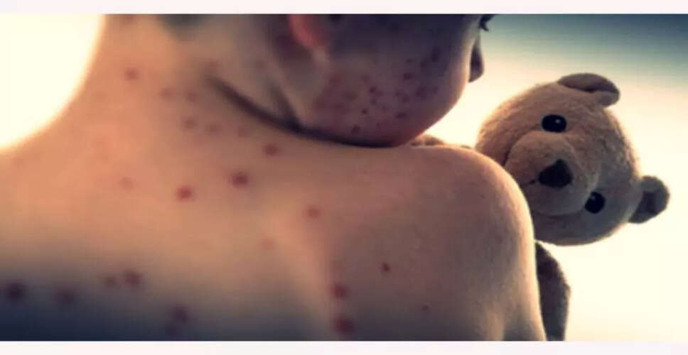 Measles Health Alert Issued in Sydney Following Confirmed Case