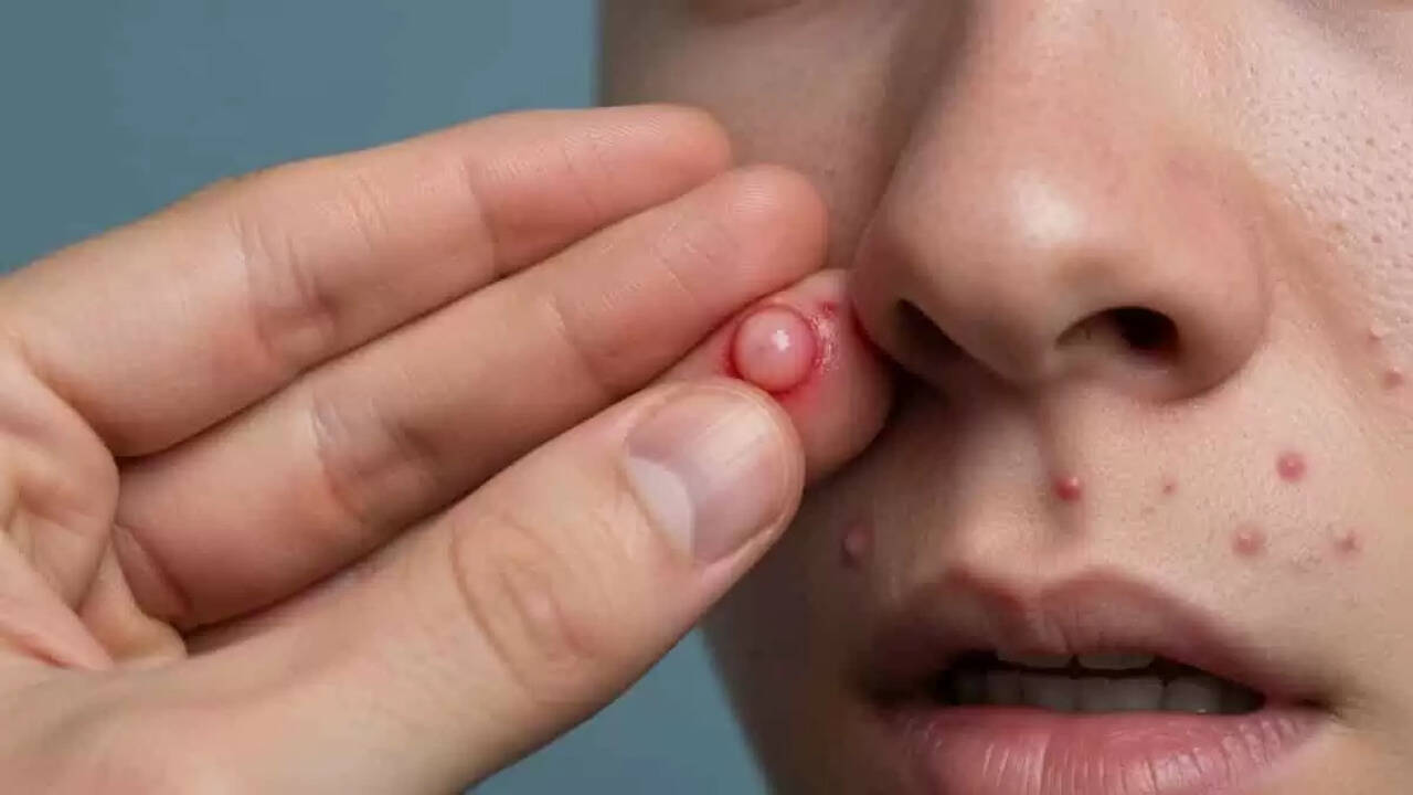 The Dangers of Popping Pimples: Understanding the Triangle of Death
