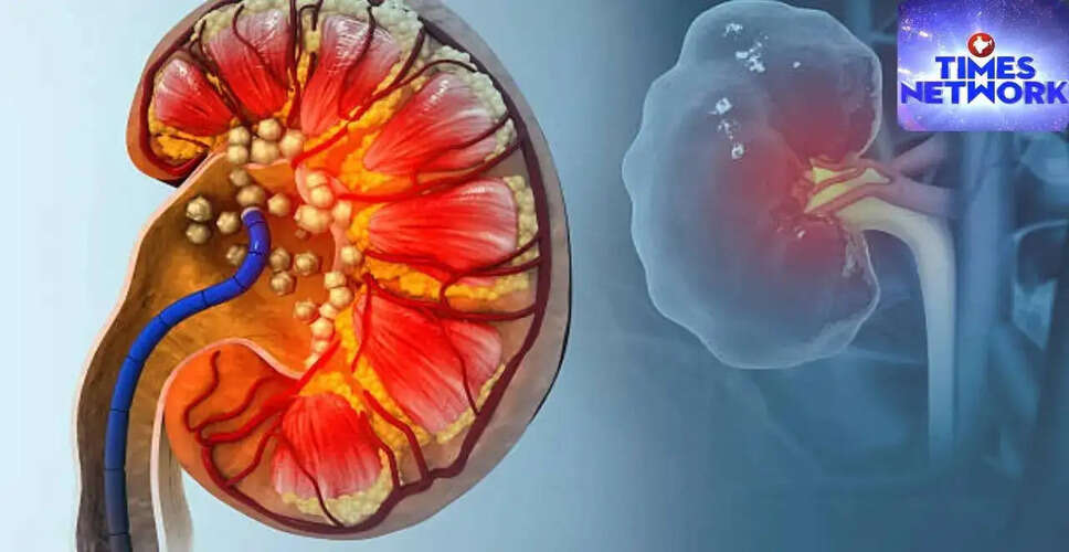 Understanding the Rise of Kidney Stones in Summer: Causes and Prevention