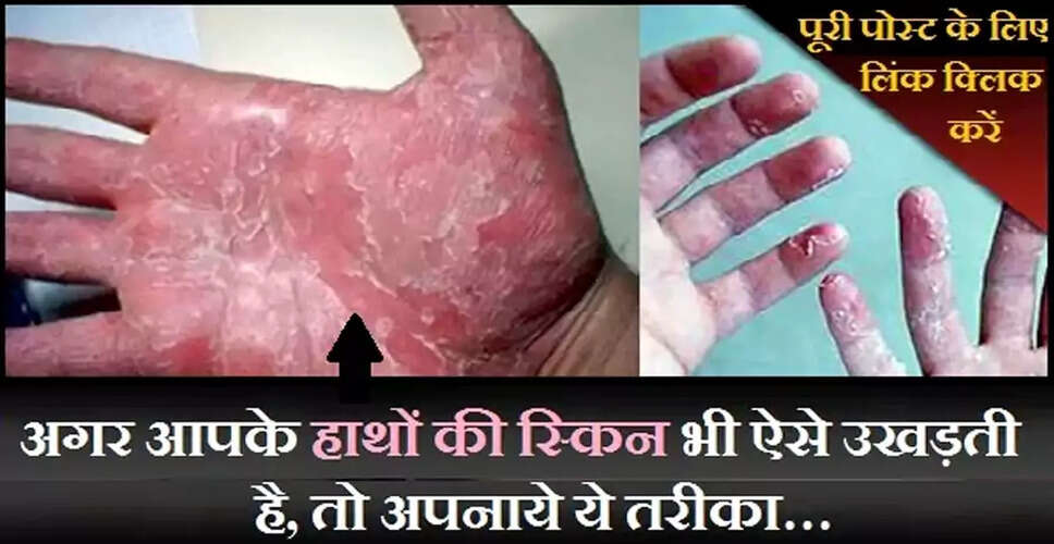 Effective Remedies for Peeling Skin on Hands