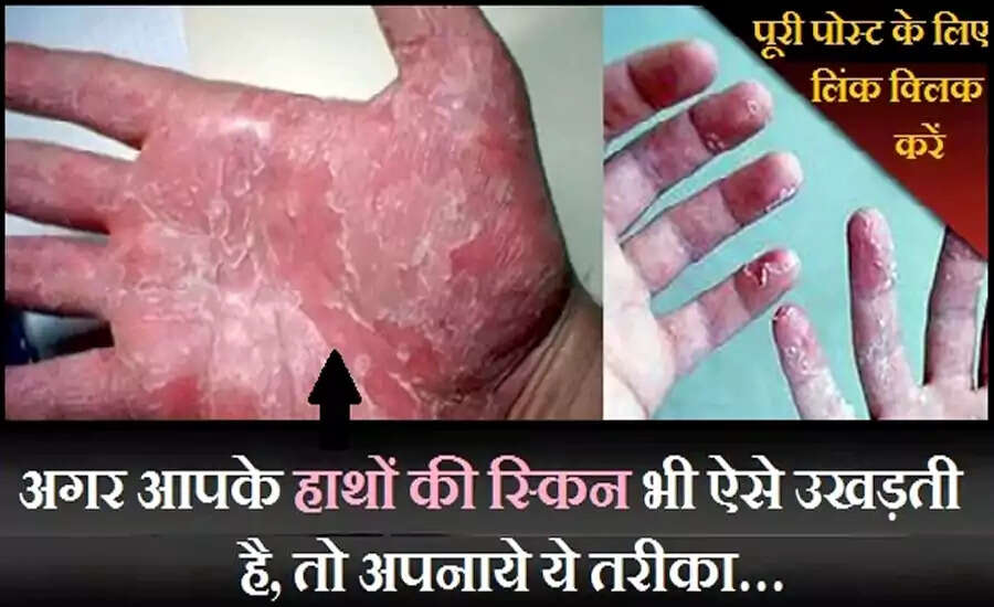 Effective Remedies for Peeling Skin on Hands