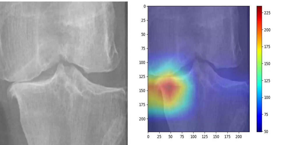 IIT Guwahati's AI model to predict knee osteoarthritis severity from X-rays