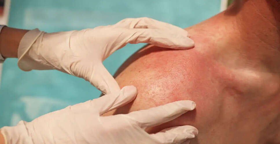 Effective Home Remedies to Combat Prickly Heat This Summer