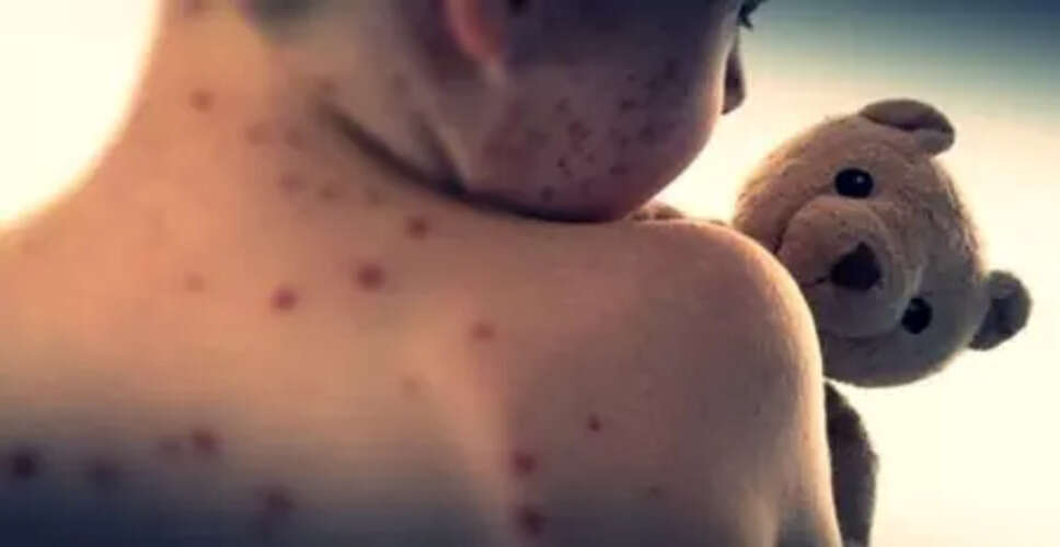New Measles Cases Emerge in Auckland Following International Travel