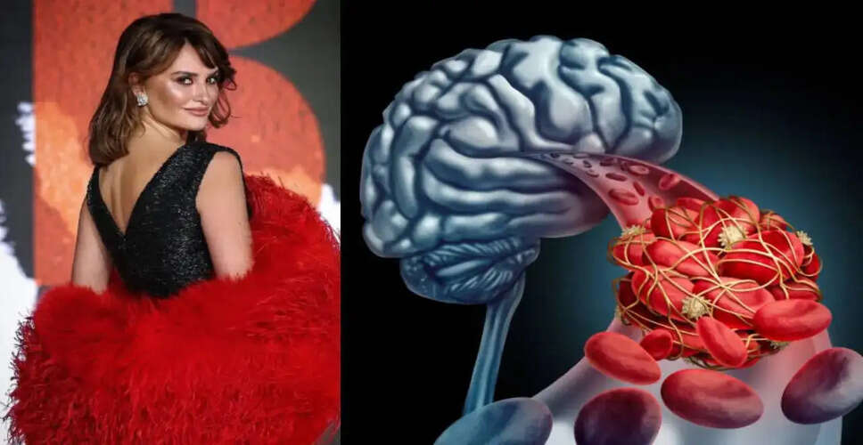 Penelope Cruz's Health Scare Highlights Brain Aneurysm Awareness