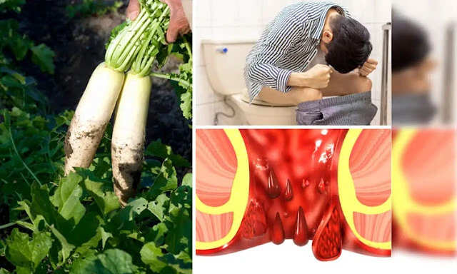 Understanding Hemorrhoids: Causes, Symptoms, and Effective Remedies