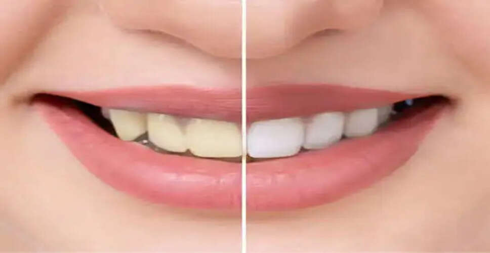 Effective Home Remedy to Combat Tooth Decay and Discoloration