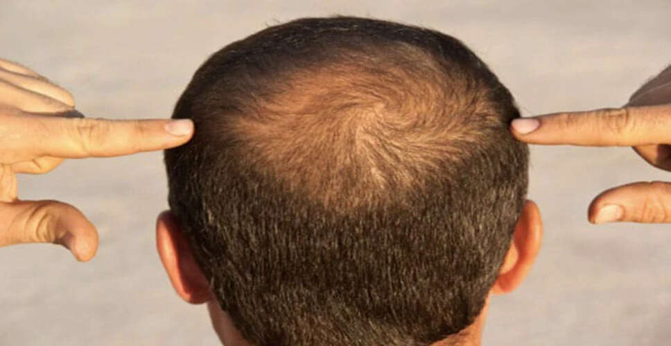 Natural Remedies for Hair Growth: Mustard Oil and Onion Juice