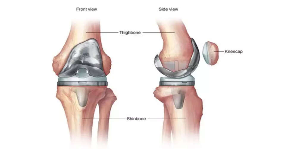Impact of Diabetes on Knee Replacement Surgery Outcomes