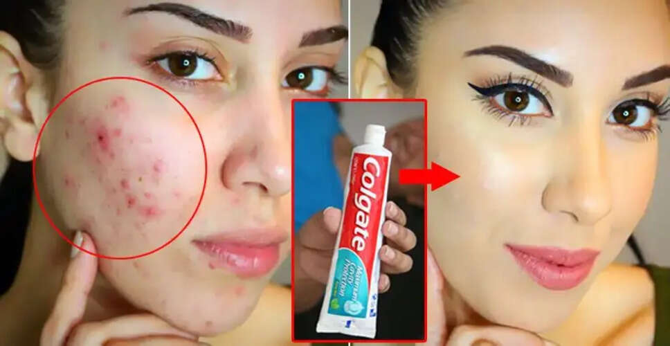 Quick Remedies for Pimples Before a Party