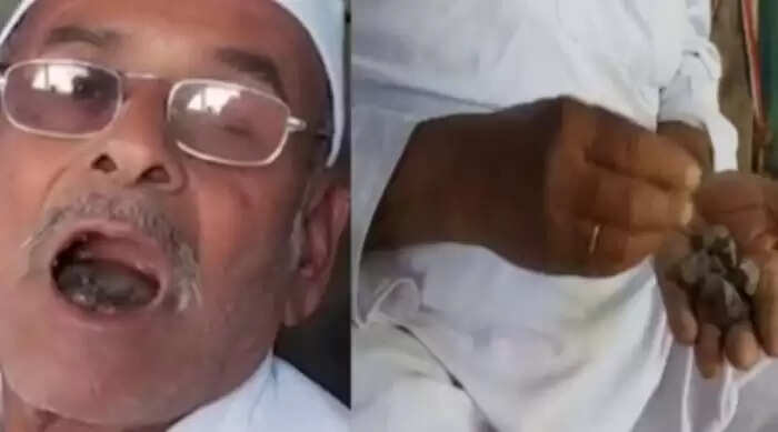 Elderly Man's Unusual Habit of Eating Stones for 31 Years