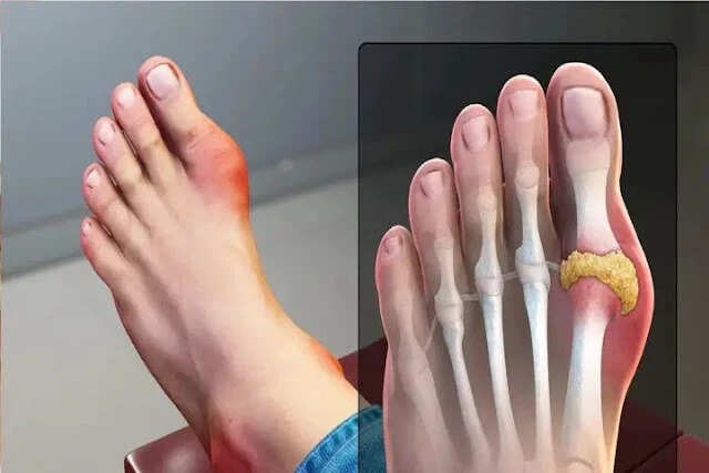 5 Affordable Fruits to Help Lower Uric Acid Levels