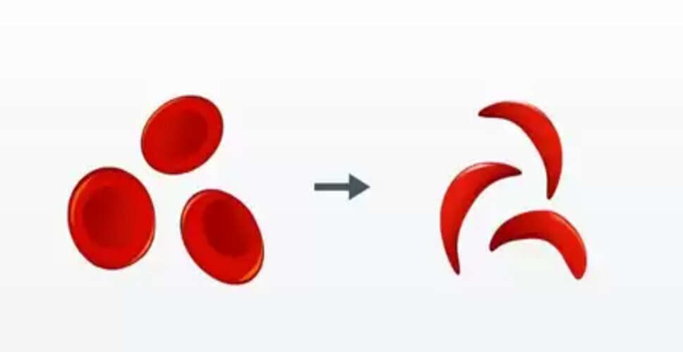 Sickle Cell Disease: India achieves milestone with 6 cr screenings, says Govt