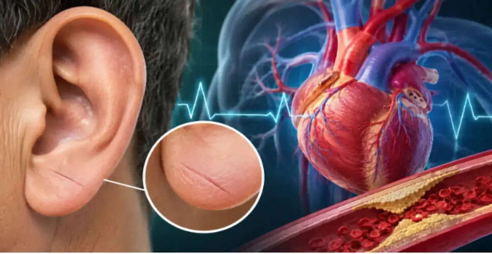 Understanding Frank's Sign: A Subtle Indicator of Heart Health