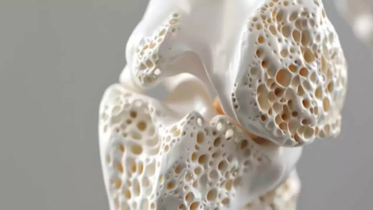 Foods That Deplete Calcium from Your Bones