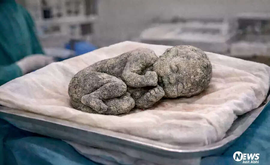 Unbelievable Case: Woman Carries Dead Fetus for 15 Years