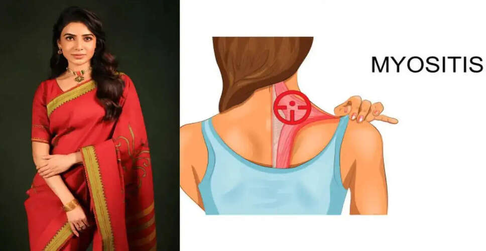 Samantha Ruth Prabhu's Pregnancy Sparks Discussion on Autoimmune Disease Management