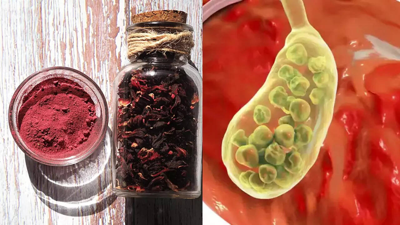 Hibiscus Powder: A Natural Remedy for Kidney Stones