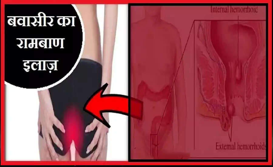 Effective Home Remedies for Hemorrhoids Relief