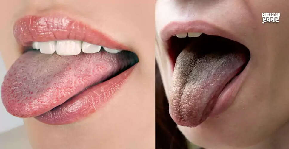 Understanding Tongue Color Changes and Their Health Implications