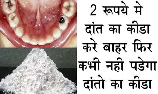 Effective Ayurvedic Remedy to Eliminate Tooth Decay