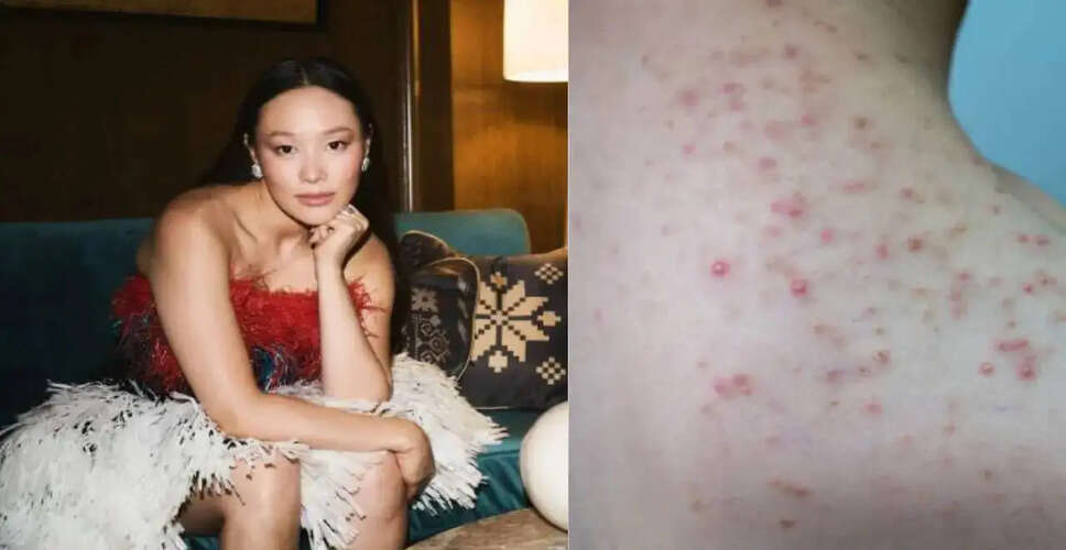 Yerin Ha Reveals Skin Condition from Steamy Scene in Bridgerton