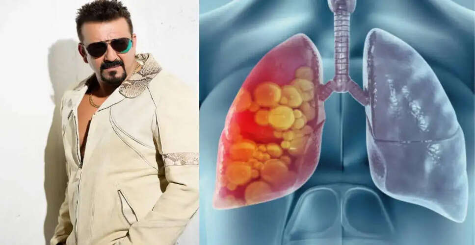 Sanjay Dutt's Health Journey: The Importance of Regular Check-Ups Post-Cancer