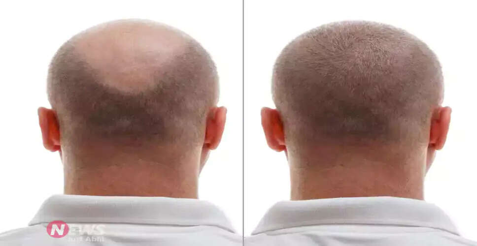 Transform Your Hair with Onion Juice: A Natural Remedy