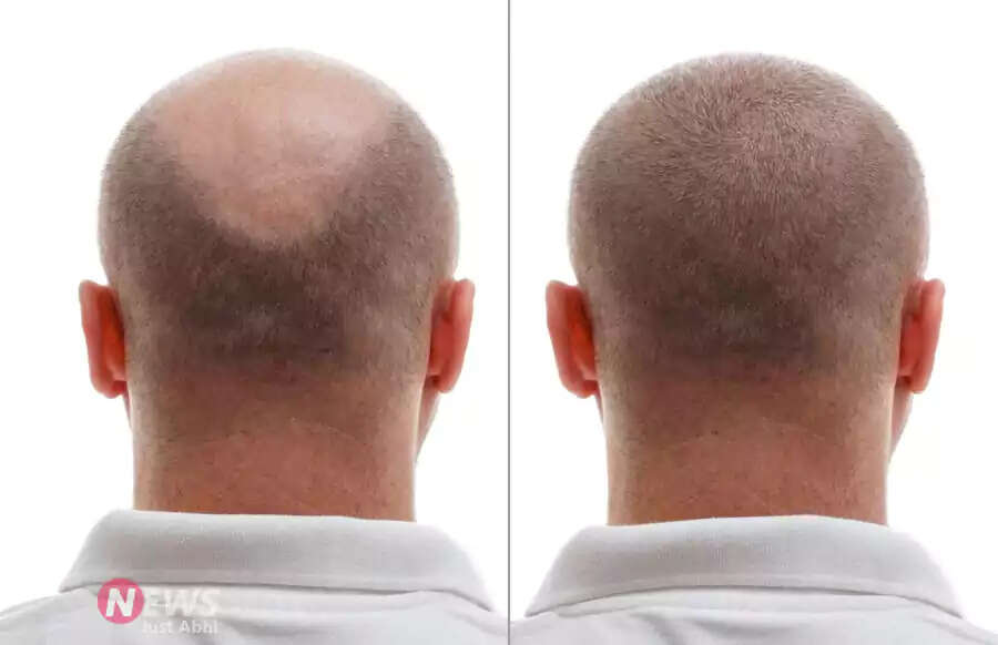 Transform Your Hair with Onion Juice: A Natural Remedy