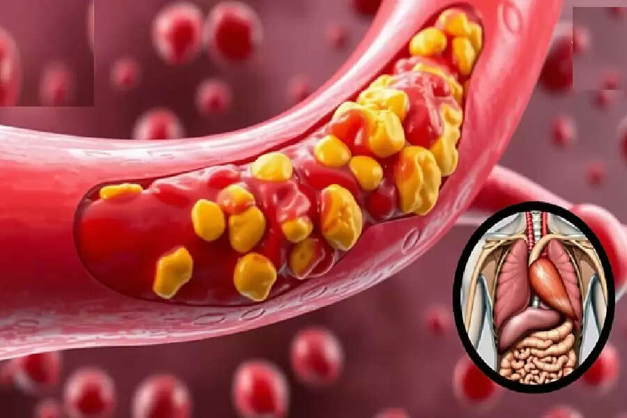 Understanding the Impact of High Cholesterol on Health