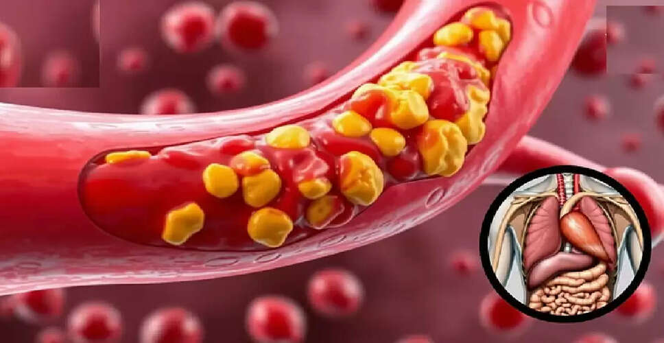 Understanding the Impact of High Cholesterol on Health