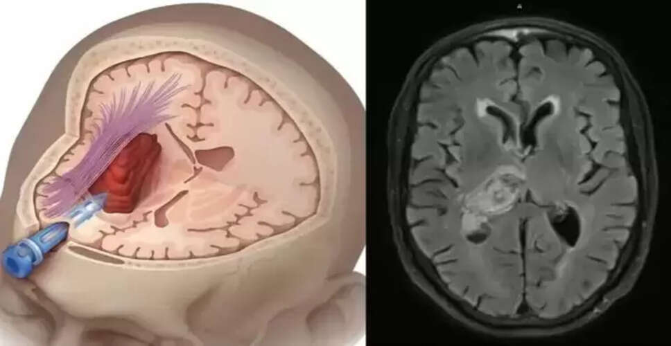 Understanding Mini Strokes: Symptoms and Prevention