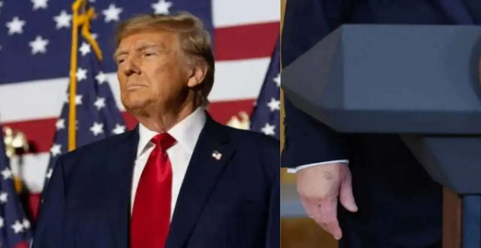 Concerns Arise Over Trump's Hand Health Following Recent Public Appearance