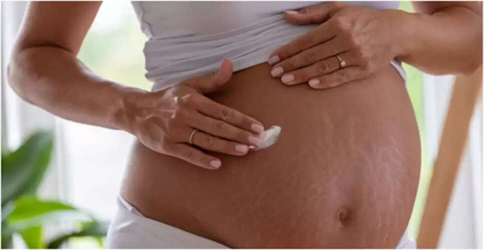 Effective Home Remedies to Eliminate Stretch Marks