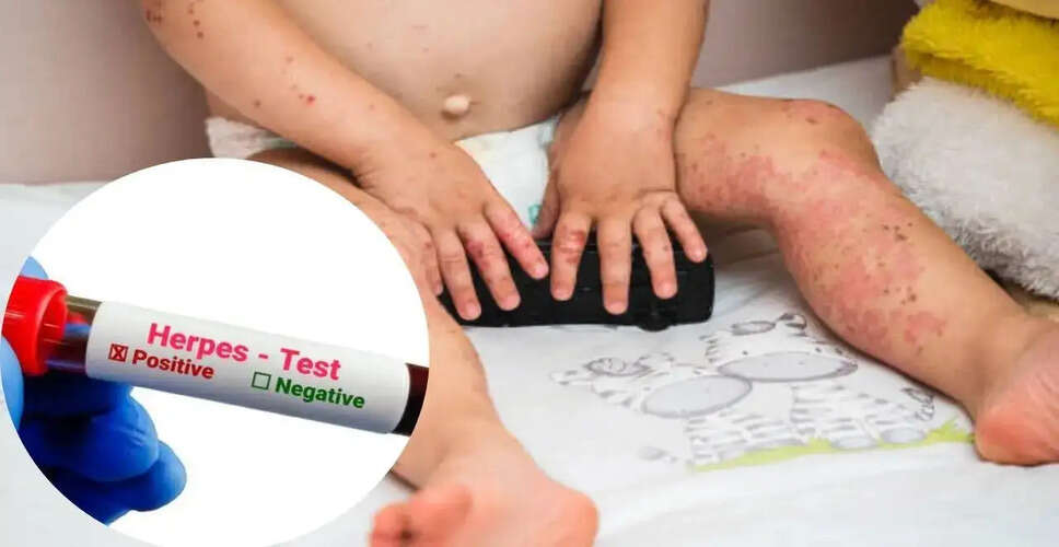 Infant Hospitalized with Herpes After Brit Milah Ceremony Raises Safety Concerns