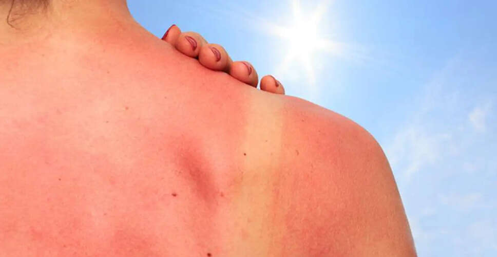Understanding Sunburn: Causes, Prevention, and Remedies