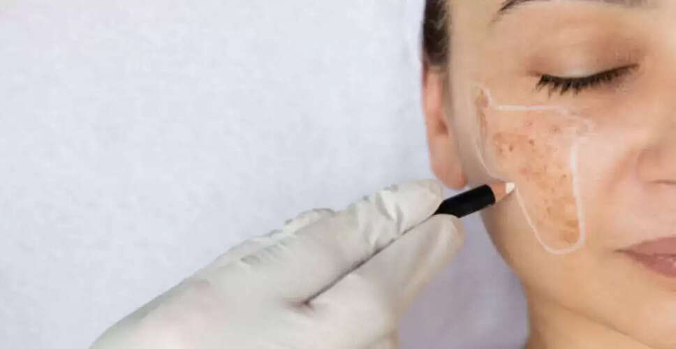 Understanding Melasma: Causes, Treatments, and Prevention Tips