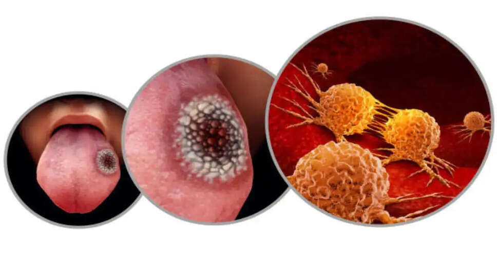 Recognizing Early Signs of Tongue Cancer: A Guide to Prevention and Treatment