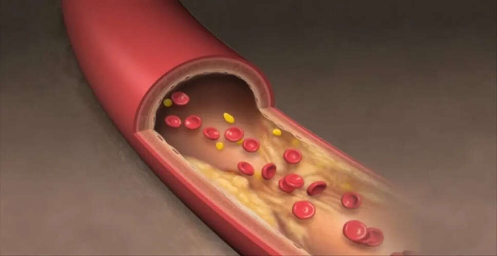 Understanding Cholesterol: Causes and Control Measures