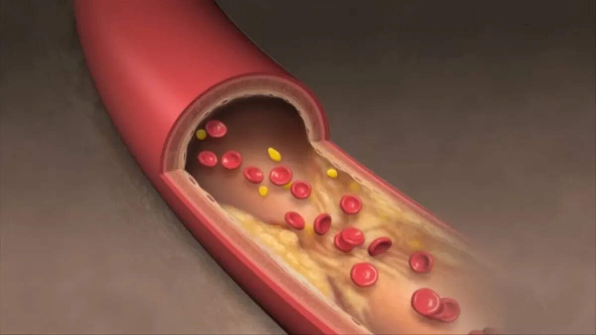 Understanding Cholesterol: Causes and Control Measures