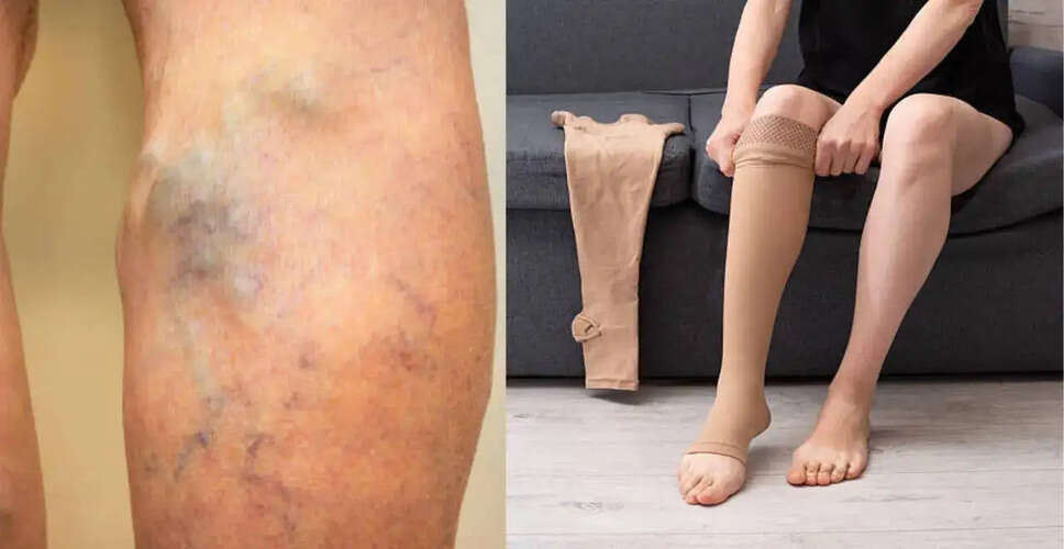 Understanding Compression Stockings for Varicose Veins: Myths and Facts